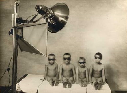 Tuberculosis phototherapy treatment on 3 March 1934, in Kuopio, Finland