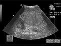 تصوير البطن بالموجات فوق الصوتية (مقطع عرضي) يظهر تشمع الكبد مع تشكيل عقدي عند طفل عمره 3 سنوات.