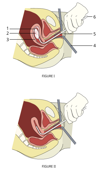 File:Vacuum-aspiration.svg