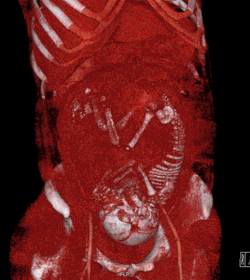 Volume rendered CT scan of a pregnancy of 37 weeks of gestational age (smaller).gif