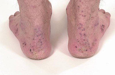 Crusts around the ankles and feet in the same patient as above