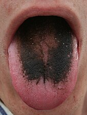 Adult tongue with a strikingly black top