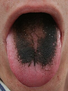 Tongue disease disease involving the tongue