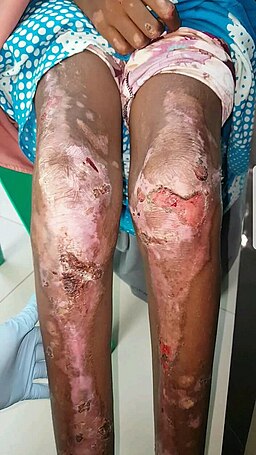 Dystrophic type of epidermolysis bullosa