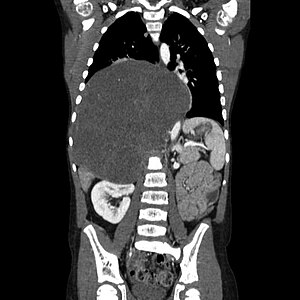 Ганглионевромы CT scan.jpg 