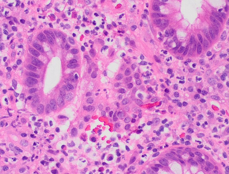 File:Histopathology of gland destruction in active colitis.jpg