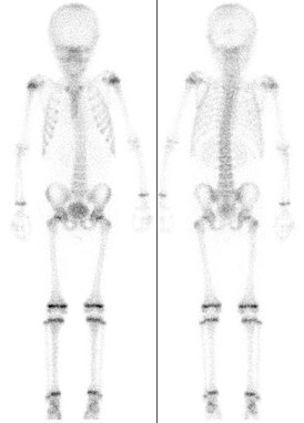 Сцинтиграфия скелета семилетнего ребёнка, демонстрирующая интенсивный обмен в зонах роста.