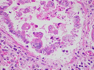 Respiratory syncytial virus (RSV) infection usually produces widespread bronchiolitis and interstitial pneumonia which may sometimes by associated with giant cells. This image shows a non-specific interstitial pneumonia pattern with no giant cells present. Respiratory syncytial virus (RSV) infection x400.jpg