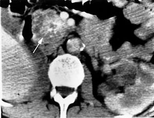 Morbus Hippel-Lindau: Geschichte, Inzidenz, Erbgang, Epidemiologie, Pathogenese, Molekularbiologie und pathophysiologische Zusammenhänge