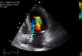 File:Stress-echocardiography-1476-7120-8-11-S1.ogv