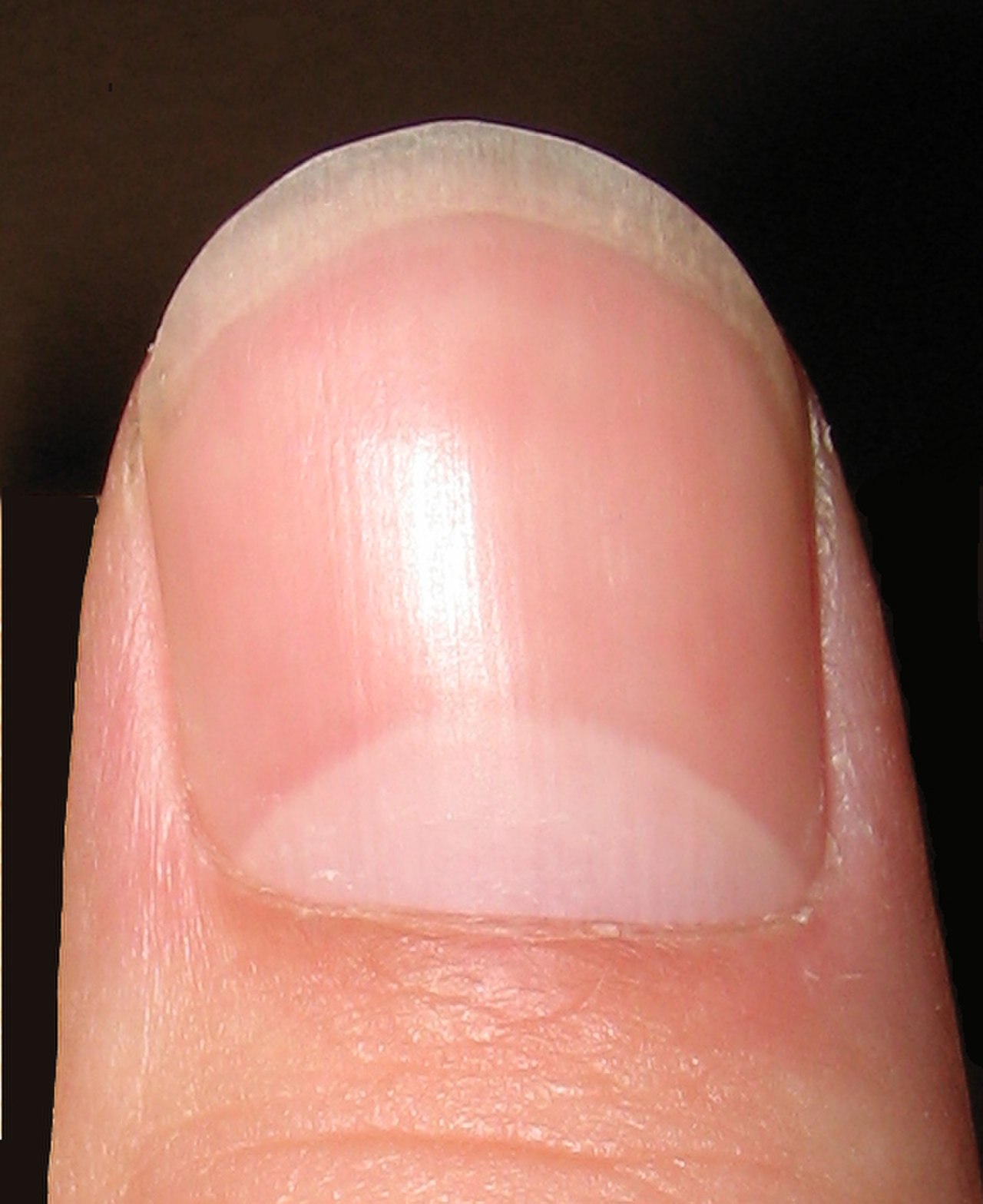 Что означают полосы на ногтях. Ногти поперечные борозды бо (линии бо-Рейля). Ногтевая пластина. Здоровые ногти.