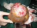 7 Huge tumor removed.jpg