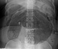 Radiographie abdominale d'un volvulus caecal