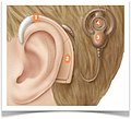 Cochlear-implant-external-part.jpg