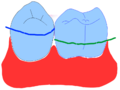 Curăţatul dinţilor prin alunecarea treptată în sus - în direcţia suprafeţei de masticaţie.