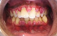 Gingivitis: Inflammation of the gums