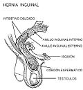 Miniatura para Hernia inguinal