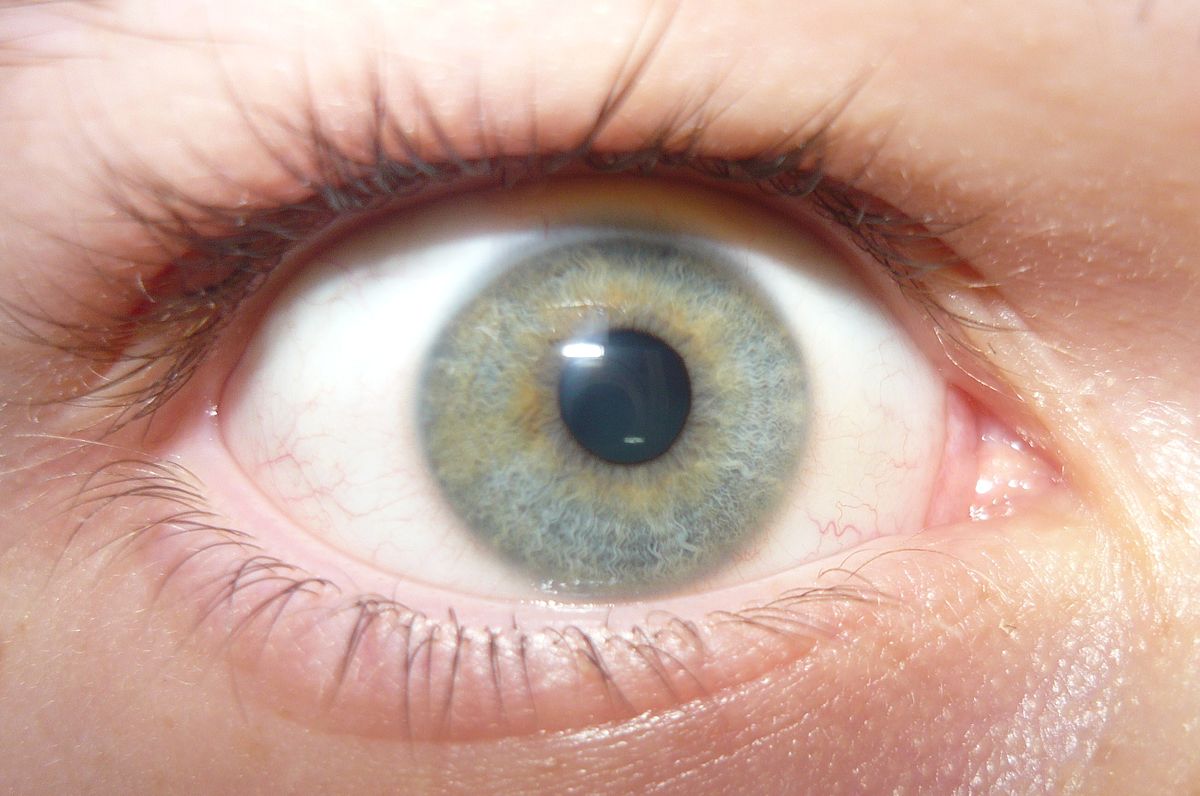File:Light blue eye with heterochromia.JPG - Wikipedia