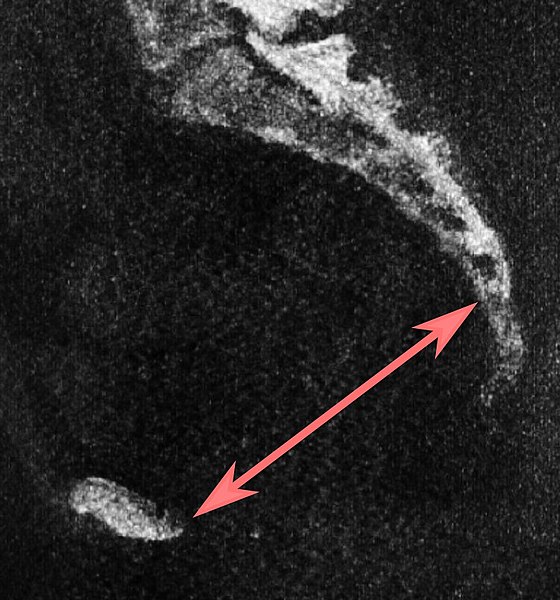 File:Low-dose CT of sagittal pelvic outlet diameter.jpg