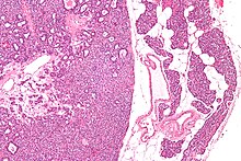 Micrograph of a parathyroid adenoma (left) and normal parathyroid gland (right). H&E stain. Parathyroid adenoma low mag.jpg