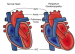 Thumbnail for Peripartum cardiomyopathy
