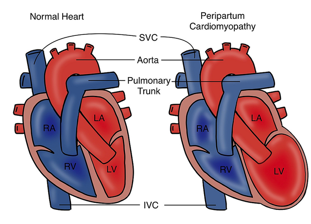 https://upload.wikimedia.org/wikipedia/commons/thumb/1/17/Peripartum_cardiomyopathy.png/640px-Peripartum_cardiomyopathy.png