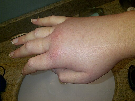 Swollen hand during a hereditary angioedema attack.