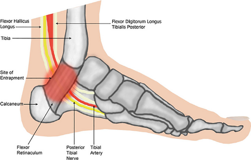 Tarsal tunnel syndrome