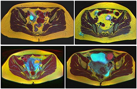 Four kinds of ovarian cysts on MRI