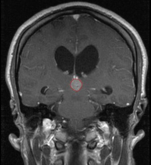 Tumor Pineocytoma2.JPG