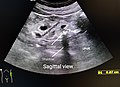 Ultrasound of left kidney lower pole with stone.jpg