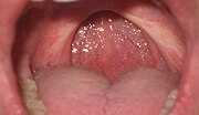 Thumbnail for File:Uvulopalatopharyngoplasty.JPG