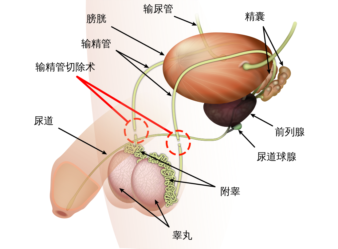 输精管切除术