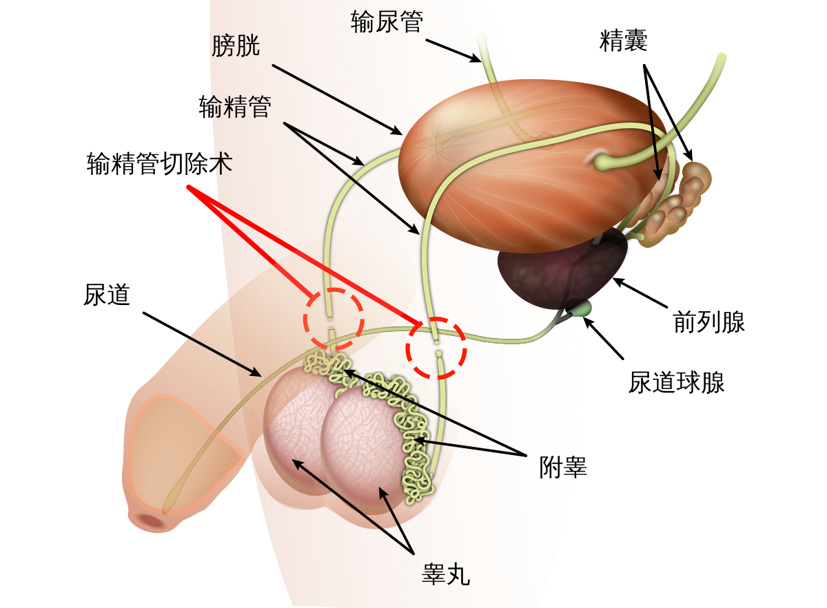 输精管切除术- 维基百科，自由的百科全书