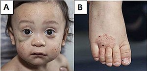 Wiskott–Aldrich syndrome petechiae, hematoma and eczema.jpg