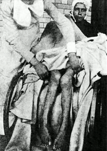 A victim of the epidemic exhibiting complete paralysis of lower limbs with atrophy 1900 Arsenical Poisoning Victim.png