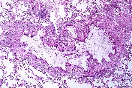 Obstruction of the lumen of a bronchiole by mucoid exudate, goblet cell metaplasia, and epithelial basement membrane thickening in a person with asthma.