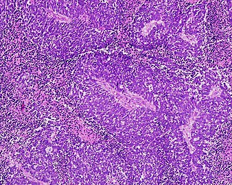 Anaplastic (microcellular, oat cell) carcinoma from the lung (histopathology)