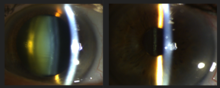 Before surgery (natural crystalline lens, left). After surgery (implanted PCIOL, right). Cataract Before & After Cataract Surgery.png