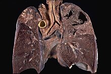 M. tuberculosis in the lungs, showing large cavities the bacteria have dissolved Cavitary tuberculosis.jpg