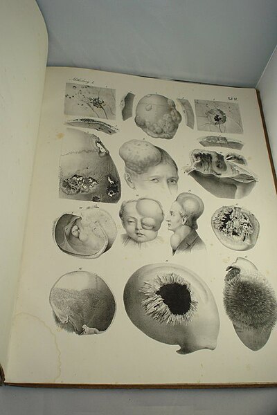 Chirurgischer Atlas der chirurgischen Krankheiten von Dr. Victor Bruns, 1853 (07).jpg