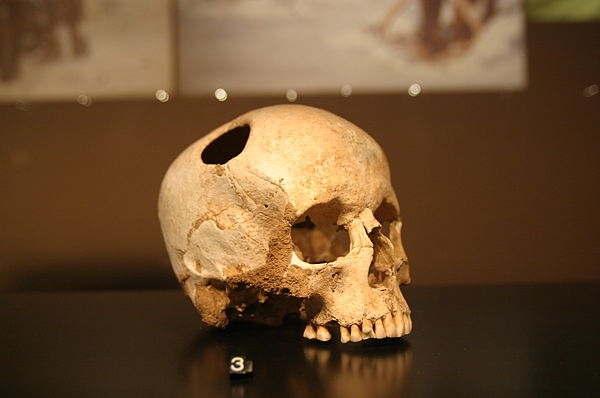 Самый древний череп человека. Инки Трепанация черепа. Древняя Трепанация черепа. Палеолитическая Трепанация черепа. Древние трепанации черепа.