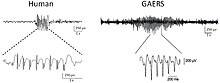 EEG of spike and wave discharges EEG decharges de pointe-ondes.jpg