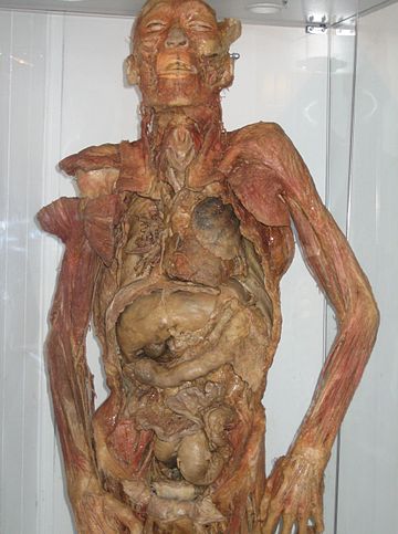 Plastination