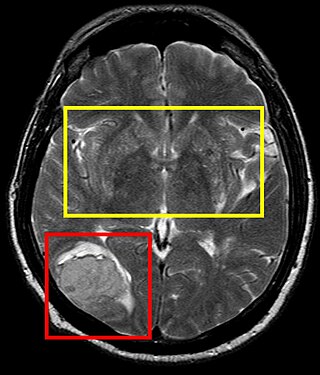 <span class="mw-page-title-main">Encephalomalacia</span> Medical condition