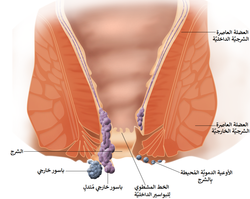 الشرج فتحت علاج التهاب