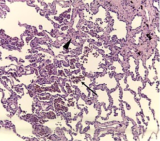 Histopathology of respiratory bronchiolitis: Smoker's macrophages (arrow); mild interstitial lymphocytic infiltrate and mild fibrosis (arrowhead) Histopathology of respiratory bronchiolitis.jpg