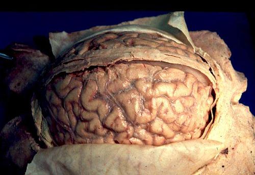 Human brain arachnoid.JPG