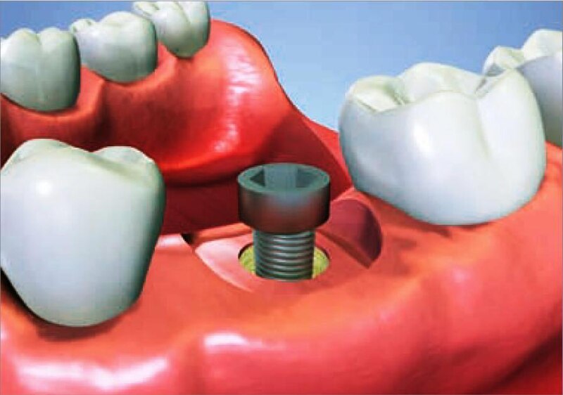 File:Implantát3.jpg