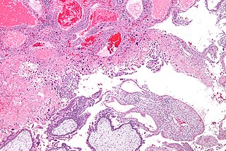 <span class="mw-page-title-main">Trophoblastic neoplasm</span> Medical condition